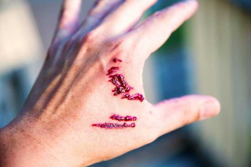 Hand with blood from dog bite